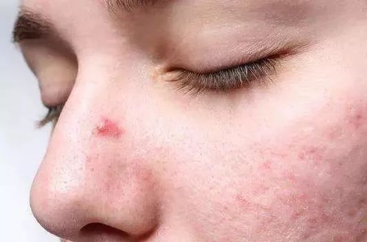 男生螨虫脸特征,螨虫脸的特征