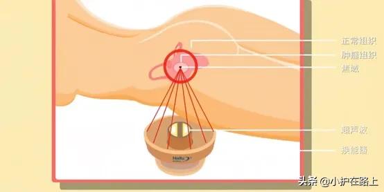 聚焦超声子宫肌瘤会复发吗,子宫肌瘤聚焦超声消融手术会痛吗