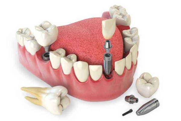 刘涛花了多少钱做牙齿,刘涛整牙花了多少钱