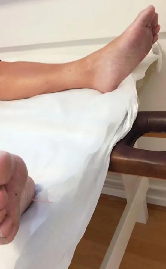 流口水针灸扎几个止涎穴,董氏奇穴治成人流口水