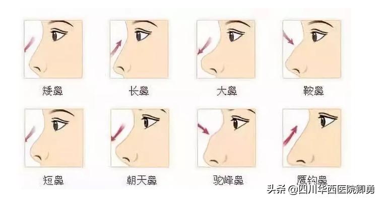 鼻部整形所有的项目,鼻部修复手术恢复