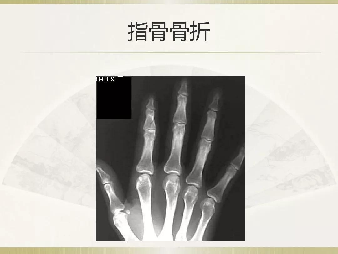 骨科x光片读片技巧,放射科骨科读片教程