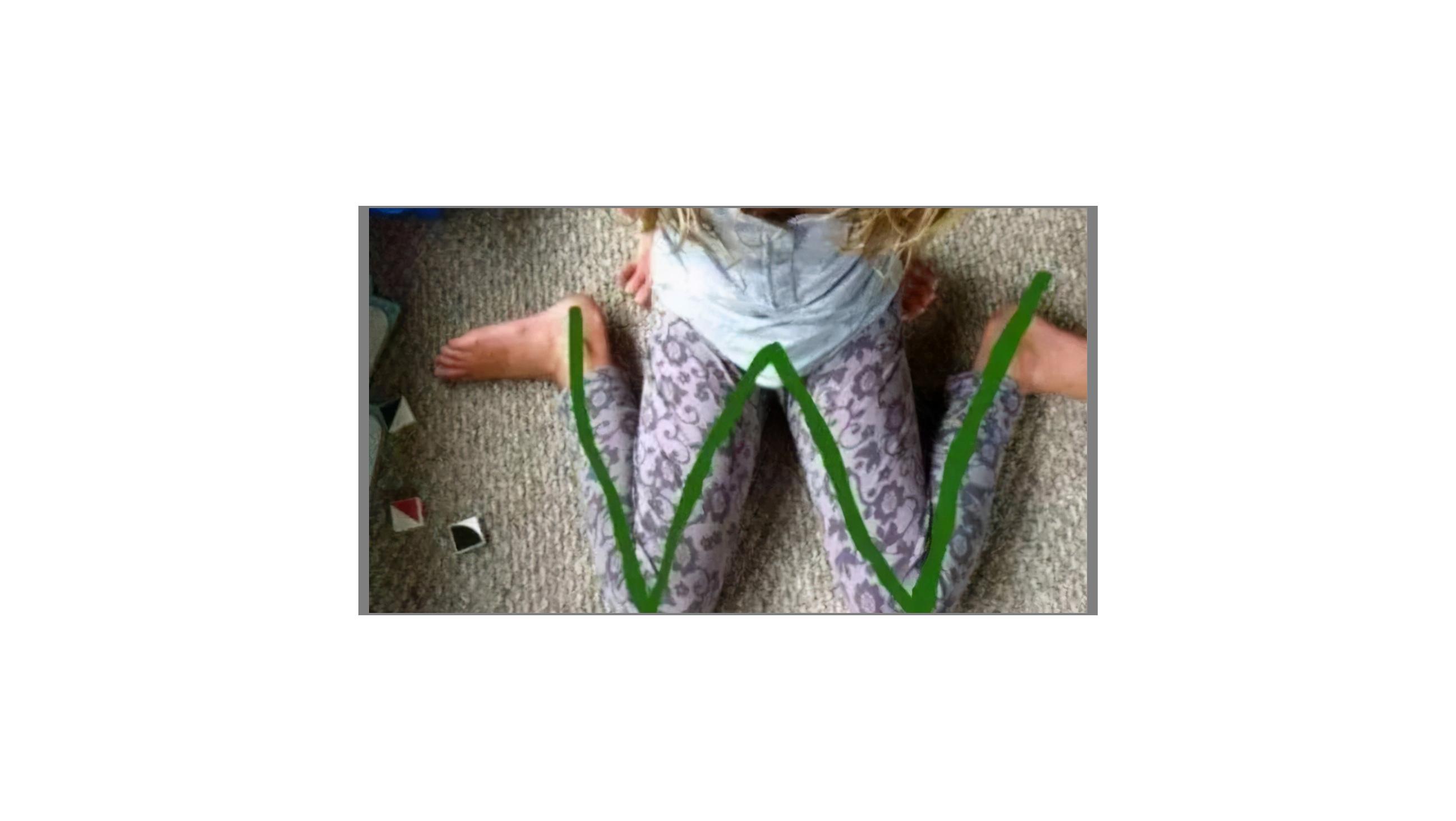 小儿歪头怎么治疗,小孩子面部倾斜怎么改正