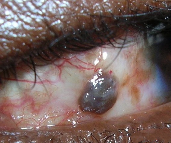 人的眼睛为什么有黑眼球和白眼球,白眼球和黑眼球交界处有个疙瘩