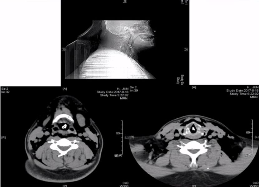 仓静教授最新视频,急性气道阻塞麻醉