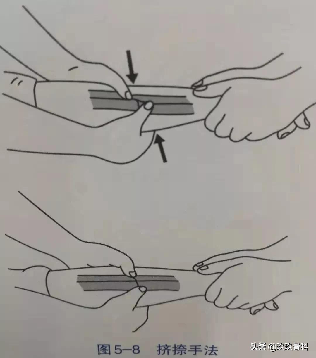 骨折手法整复术多少钱,骨折恢复手法视频教程