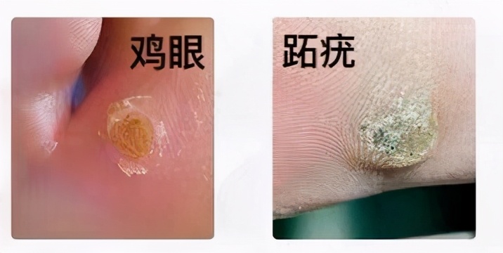 针眼、跖疣、毛囊炎，化脓了怎么办？千万别挤