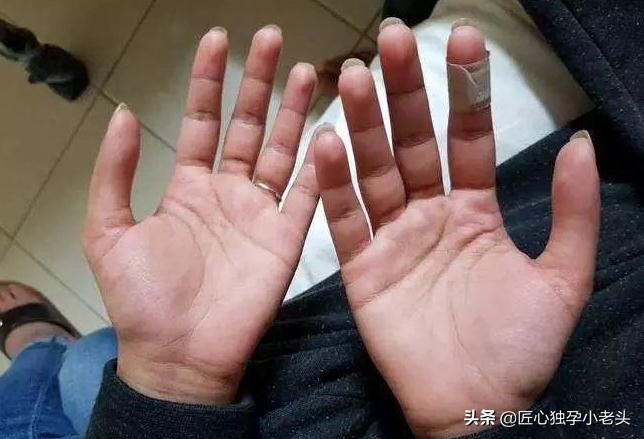 儿童为什么腿长身体短,儿童腿一长一短是正常还是不正常