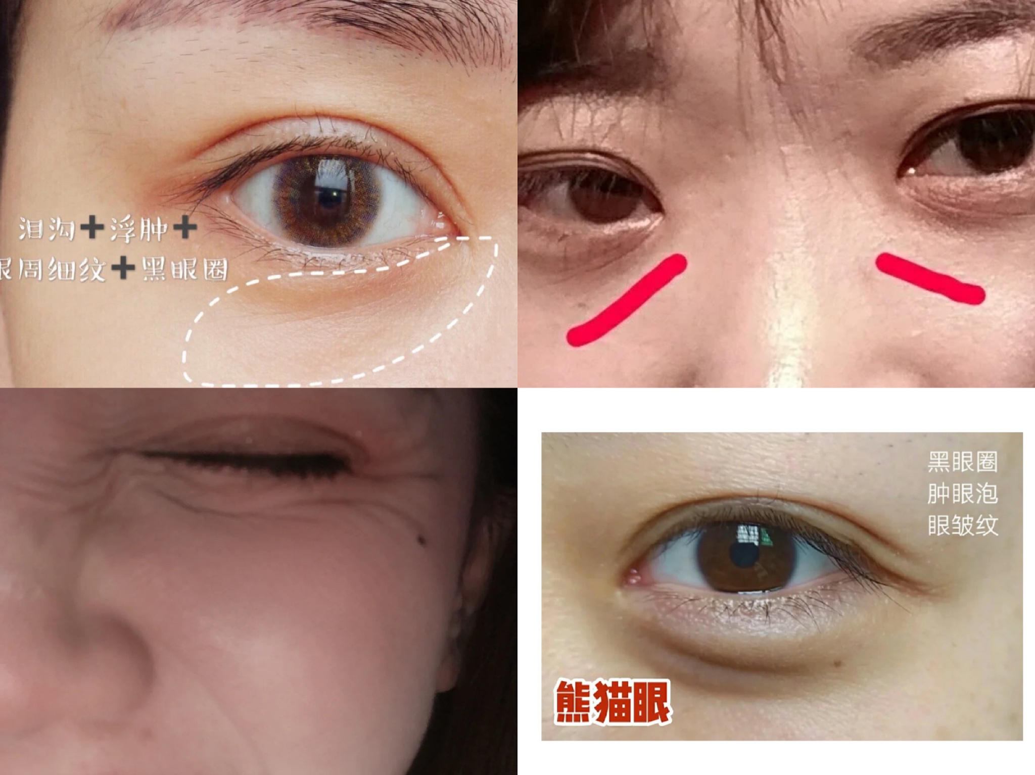 药店卖的眼霜推荐哪个牌子,无意中发现药店有一款医用眼霜