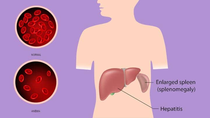 体检说脾增大什么意思,体检报告说肝硬化可能性比较大