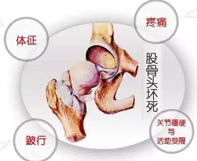 股骨头坏死多年全髋置换康复,股骨头坏死康复后还会复发吗