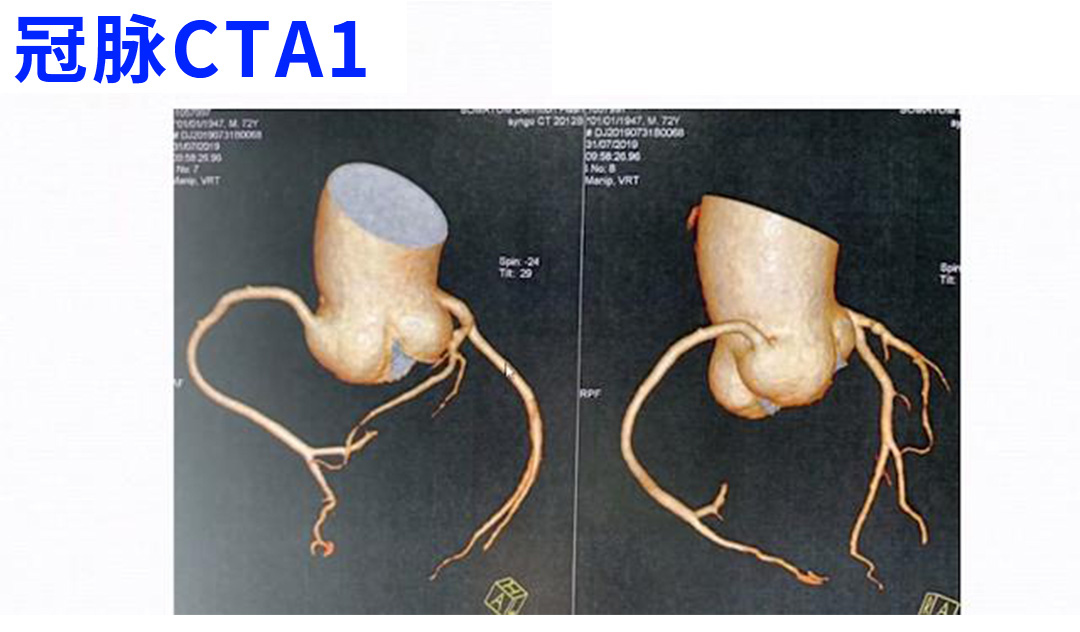 冠脉没有狭窄是否排除心肌缺血,冠脉不堵塞却心肌缺血怎么治疗