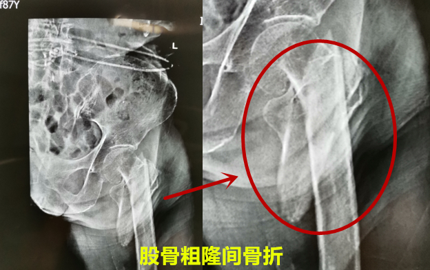 老人摔一跤屁股骨折,老人一屁股坐在地上大腿骨折