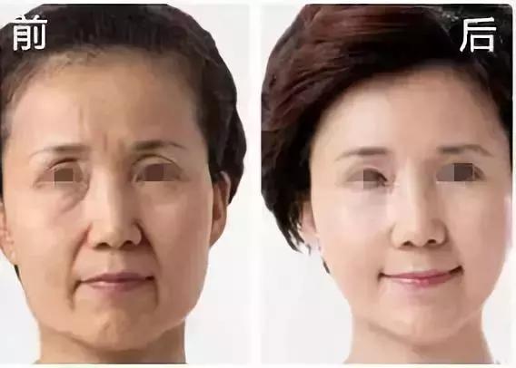 线雕加玻尿酸可以保多长时间,玻尿酸加线雕隆鼻能半永久吗