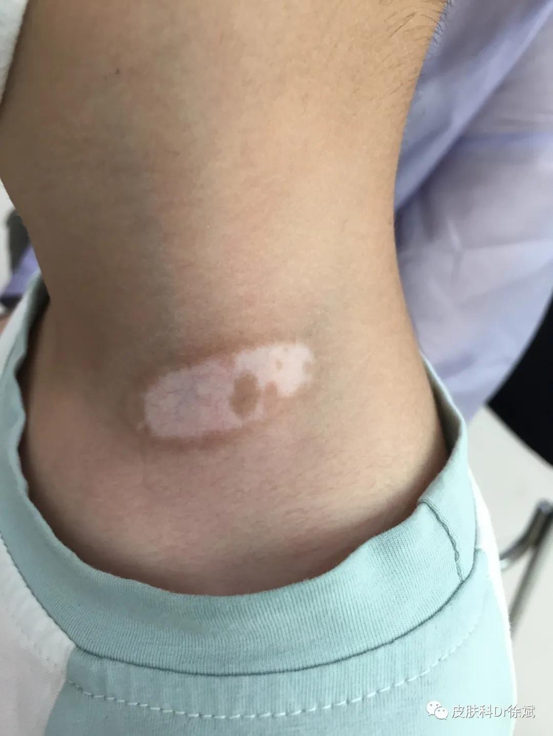 儿童治疗白癜风需要多少钱,uvb治疗白癜风多久见效