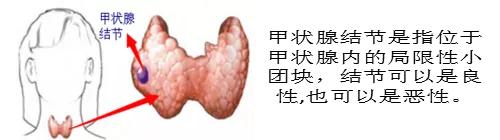 发现甲状腺结节和乳腺结节怎么办,怀孕后发现甲状腺结节4a级怎么办