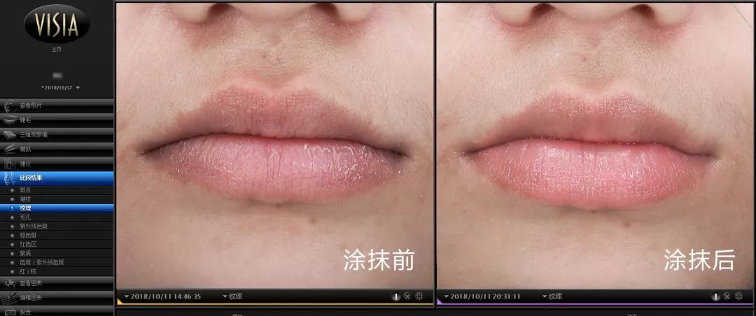 在线等,接吻时咬下女友的死皮,怎么办?