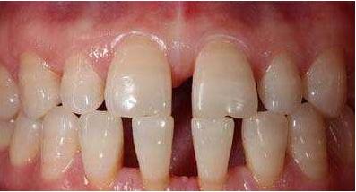 牙缝变大咬东西酸软无力,牙缝变大不舒服