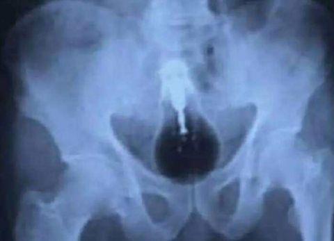 不作死就不会死,看看这些被人类搞进身体里的异物