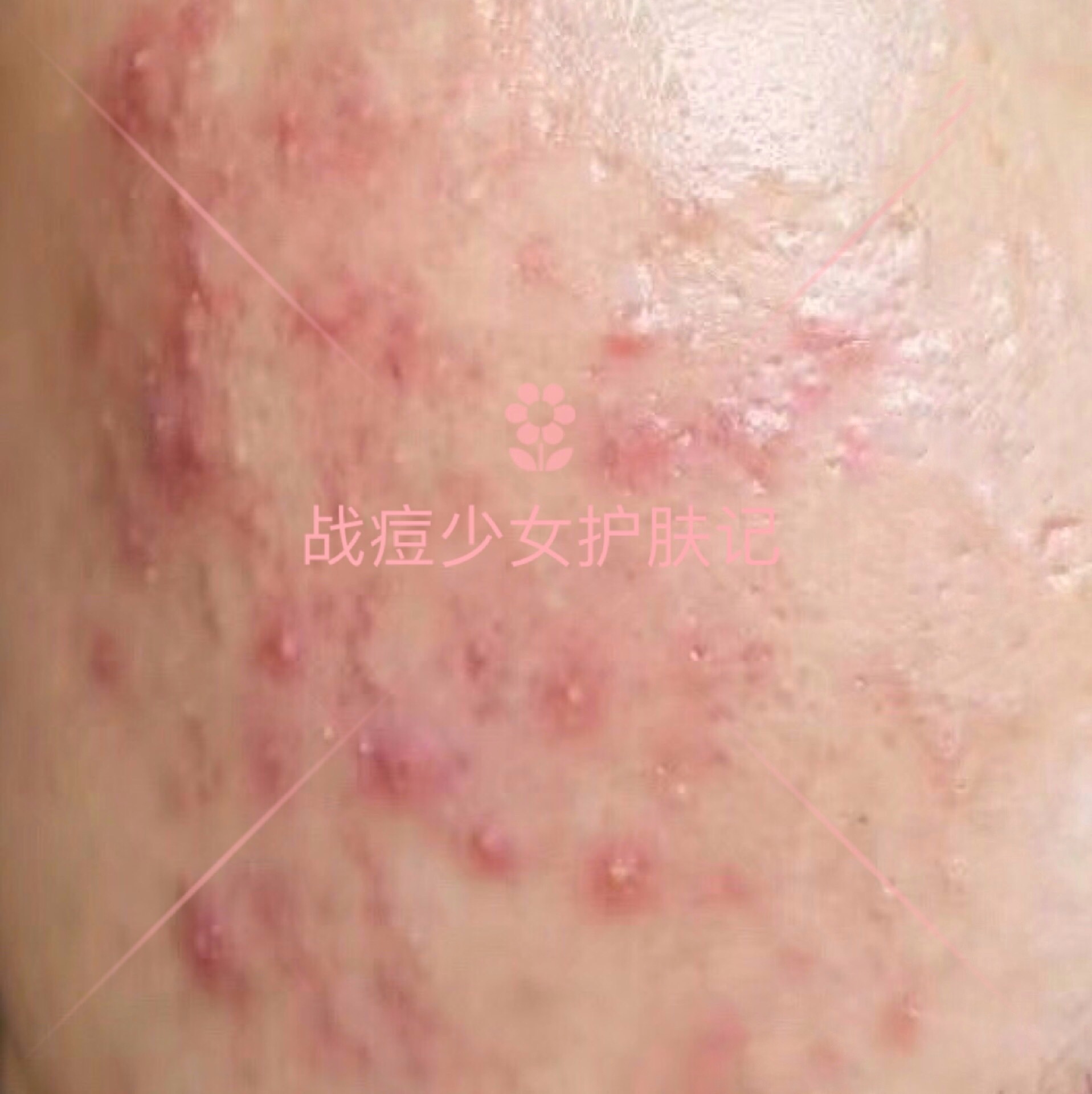 四种痘痘最佳治疗方法,各种痘痘的对症用药