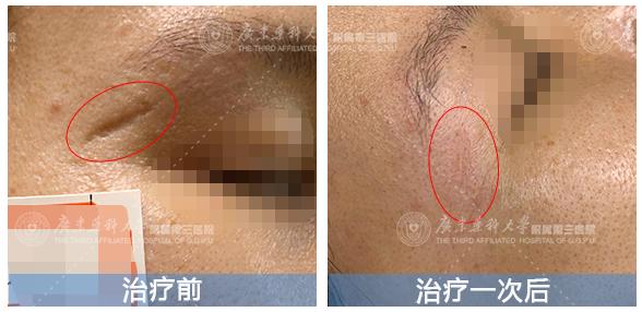 疤痕治疗能恢复原样吗,疤痕治疗了2年了还是红痒