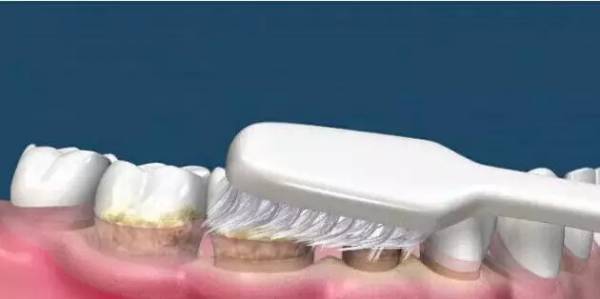 洗牙到底怎么洗好,洗牙洗的不干净