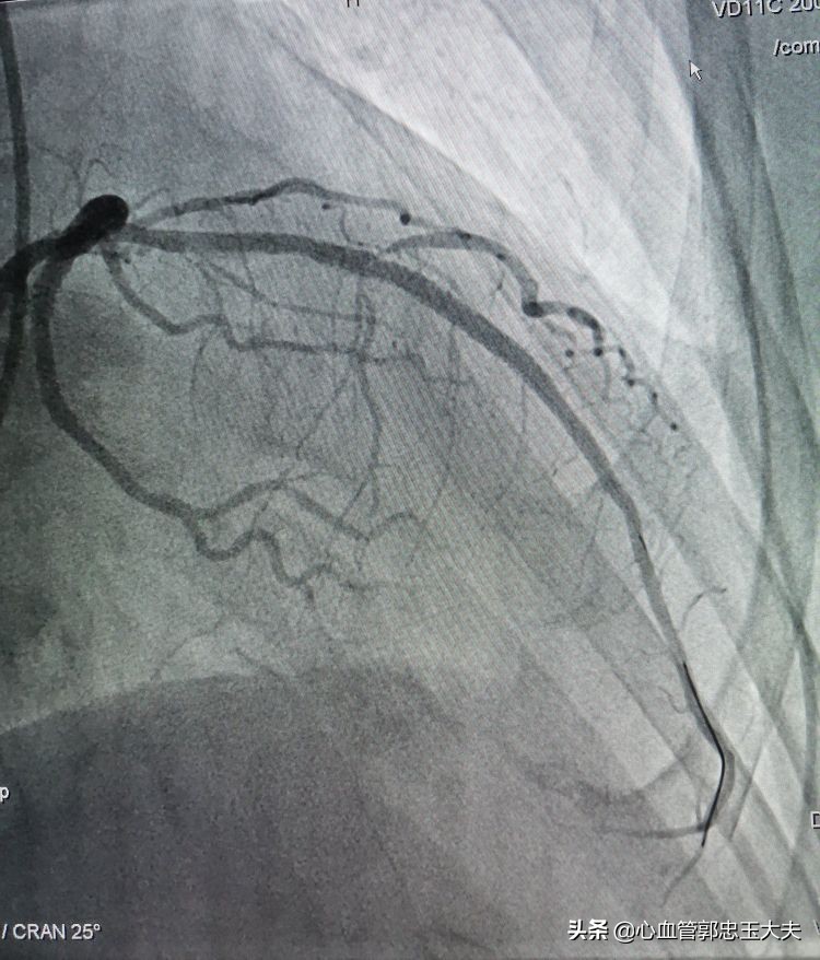 CTO遇到钙化病变怎样才能把血管打通？