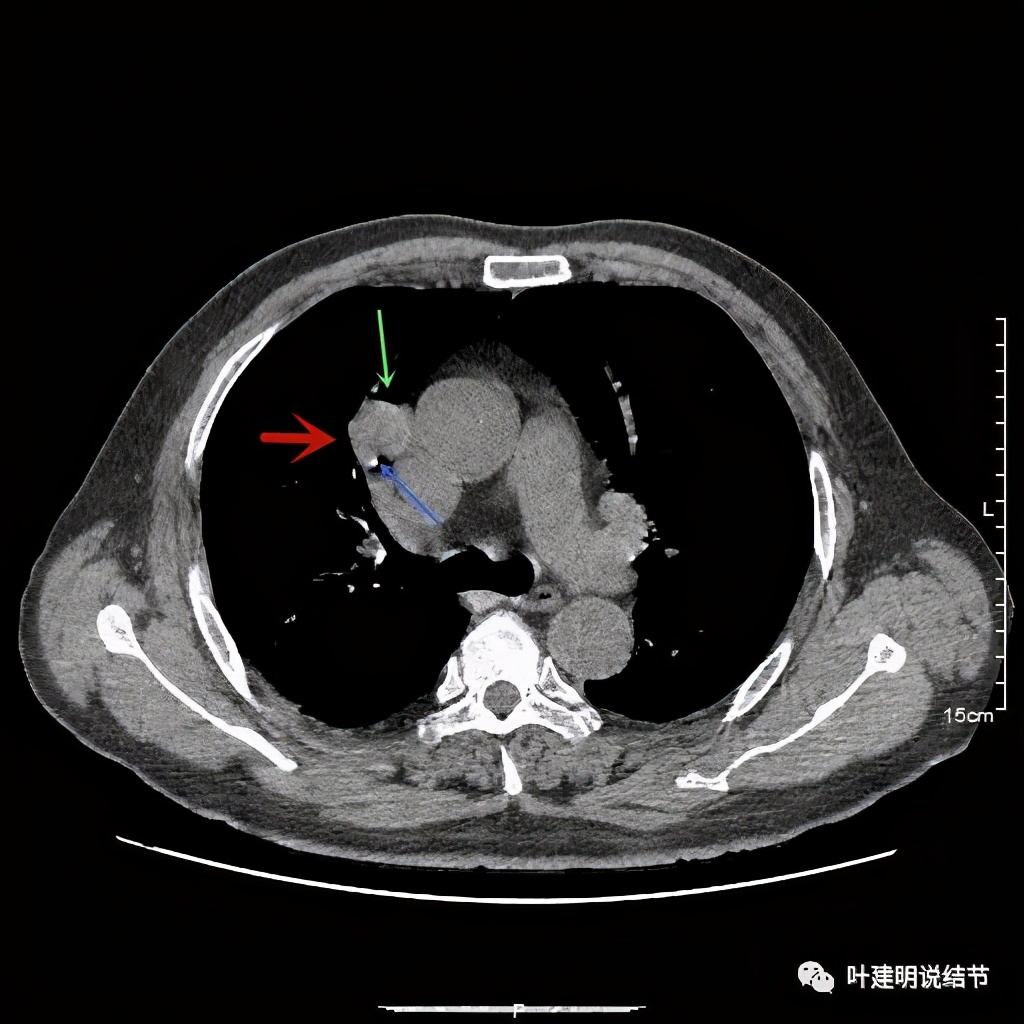 误诊报告图片,误诊案例及案例分析