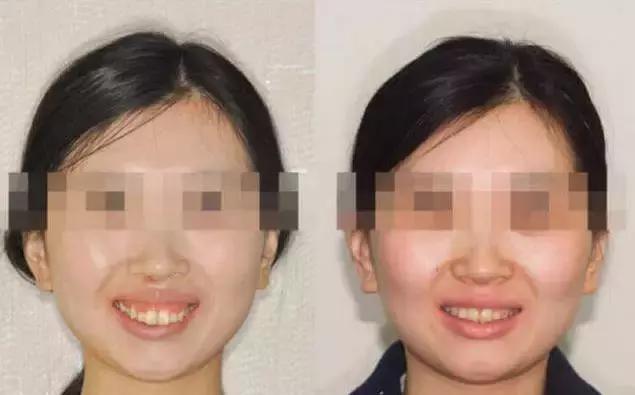 龅牙牙齿矫正的最佳方法,龅牙凸嘴露龈笑