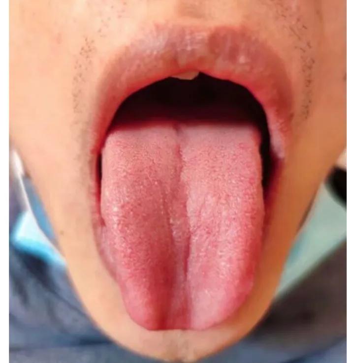 舌诊图解与针灸治疗,古法针灸点穴大全视频