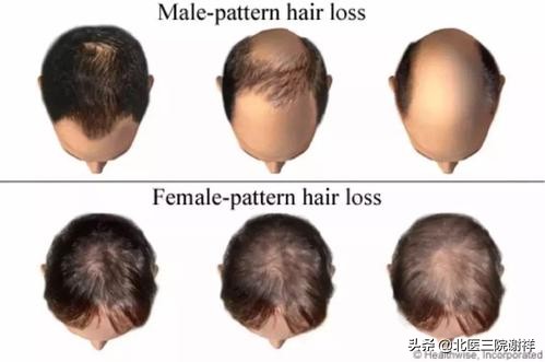 想要远离脱发远离八大误区,预防脂溢性脱发应避开这两大误区