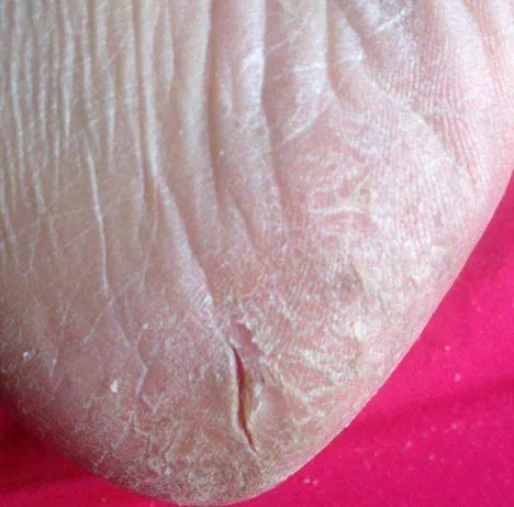 角质去除小妙招,角质层真菌怎么消除最快