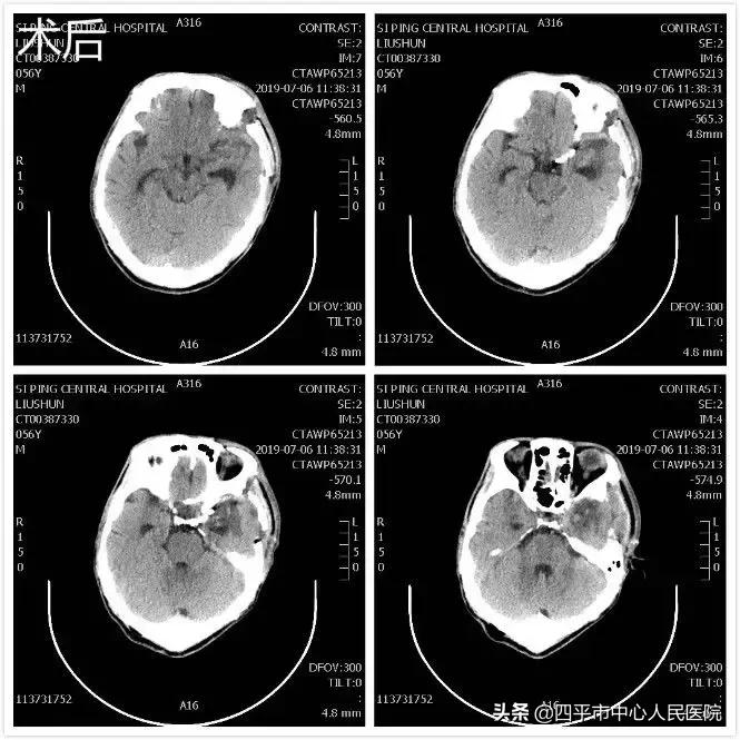 精准排雷再现新高—神经外科在6月份成功救治6例颅内动脉瘤患者