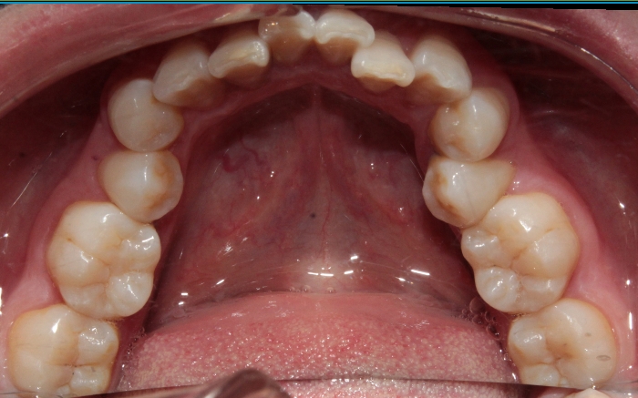 南京牙齿矫正内倾,南京牙齿矫正比较好的医院有哪些