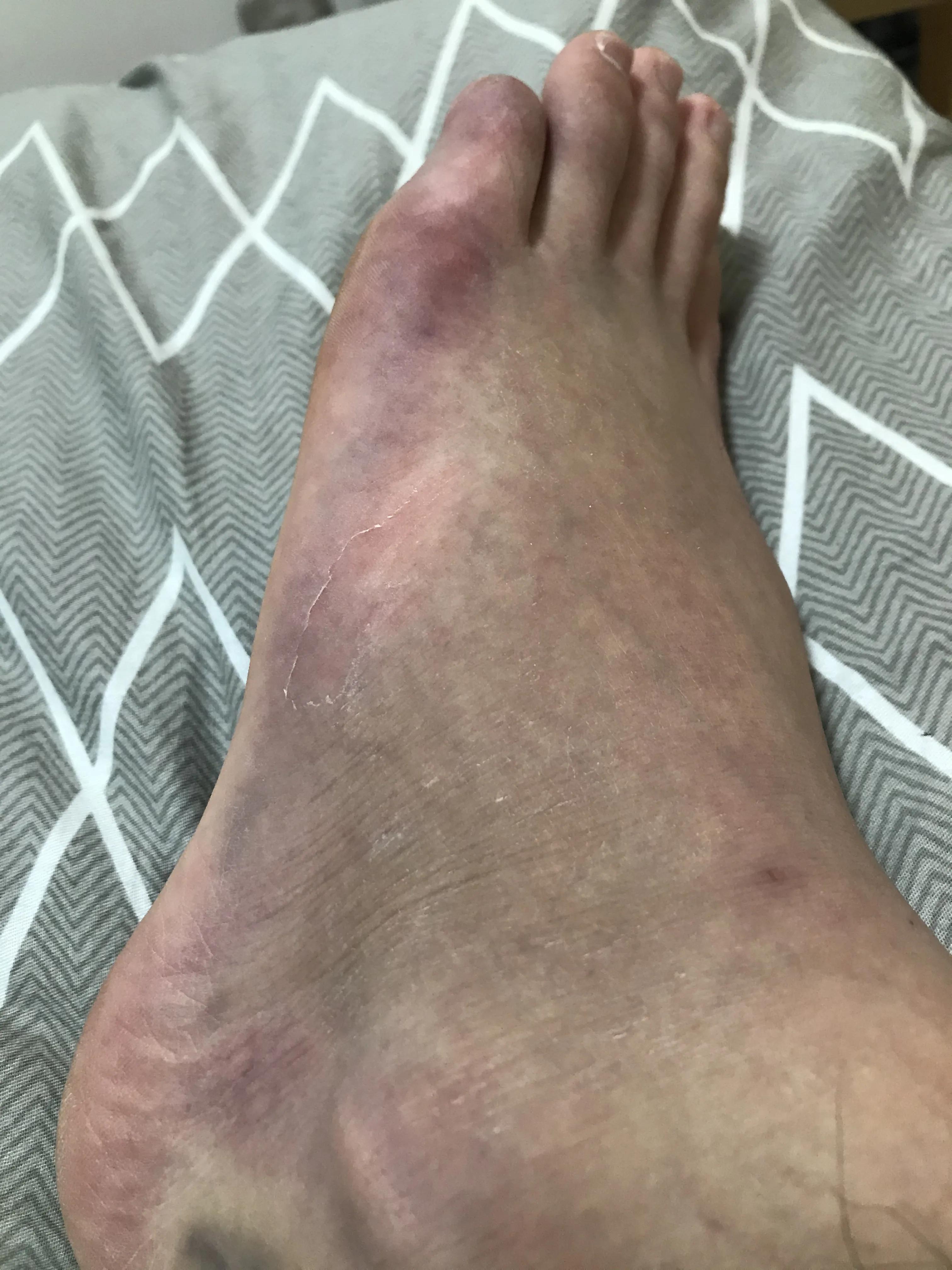 第五跖骨粉碎性骨折多久后能走路,第五跖骨基底骨折100天了走路肿