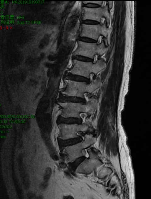 腰椎管狭窄症手术好么,腰椎管狭窄手术和保守治疗哪个好