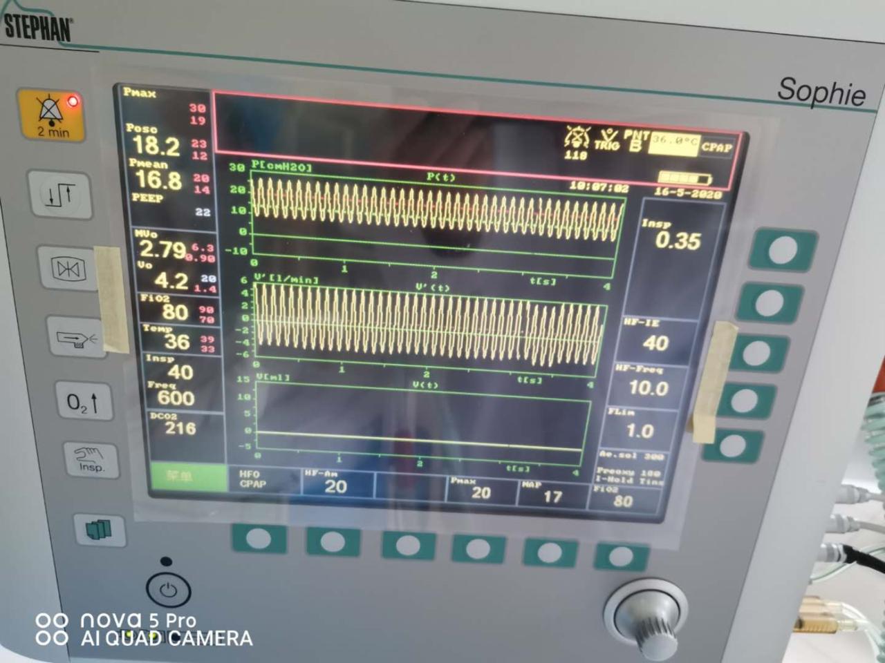 喜报我院,早产儿抢救室用呼吸机