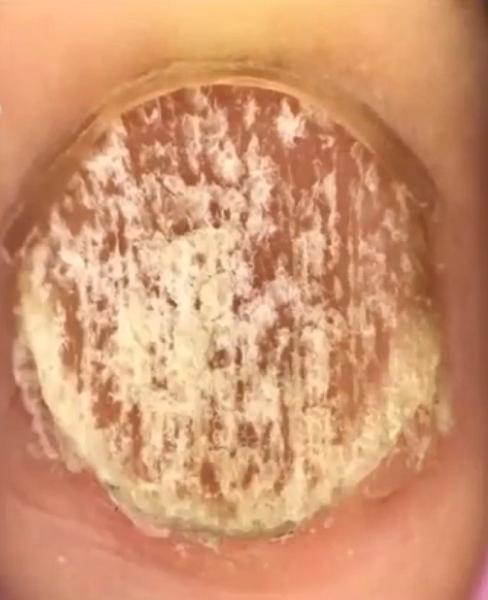 治灰指甲要验血吗,医院检查灰指甲挂号什么科