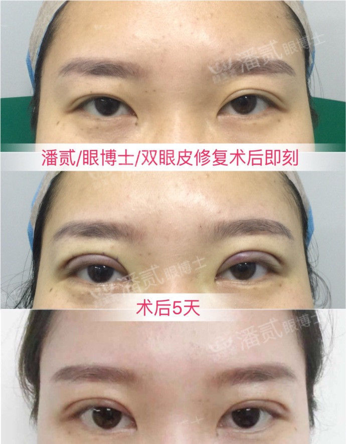 双眼皮术后恢复不一致正常吗,双眼皮术后看着不对称