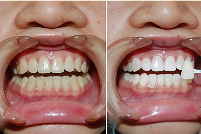 皓齿美白的真实感受,皓齿美白后酸痛严重
