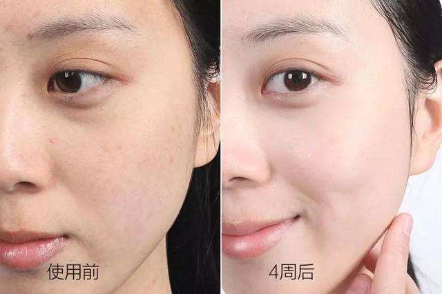 蜂蜜和开塞露一起能淡斑吗,开塞露加蜂蜜美白淡斑的正确方法