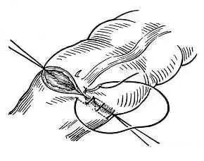 外科8种缝合方法图解,外科基本缝合方法实验报告