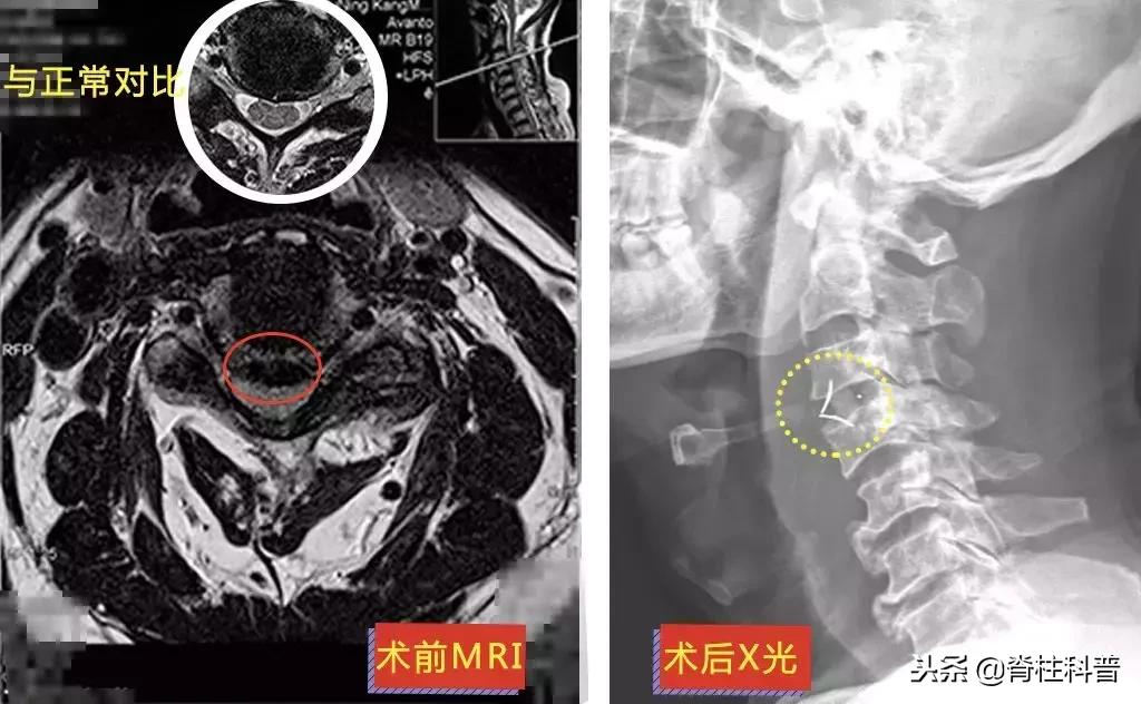 颈椎病治疗的分享,关于颈椎病通俗易懂的科普