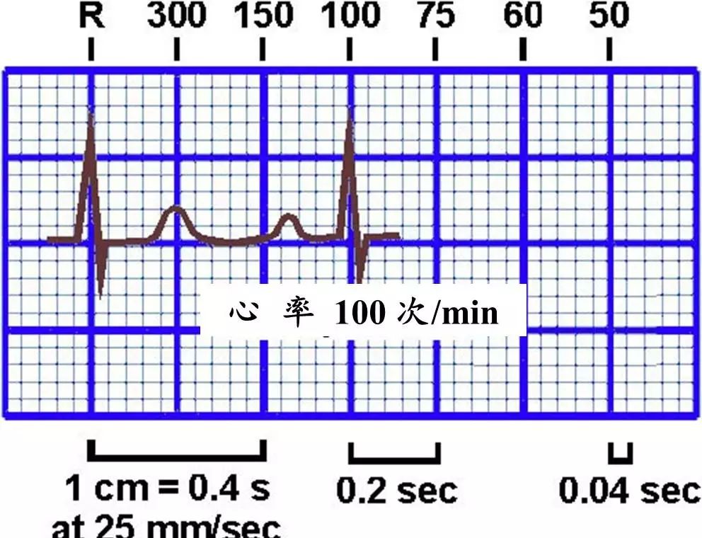 心律失常55分钟讲解,心律失常心电图讲解视频教程全集