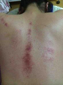 太原中医针灸科,迎泽区针灸