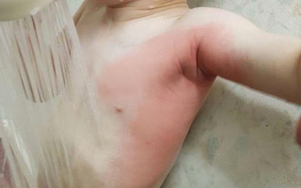 两孩子被烧伤,两小孩被烧伤