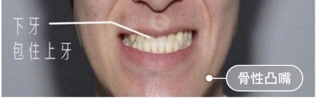 有一个牙齿凹陷怎么矫正,口呼吸导致牙齿畸形怎么矫正