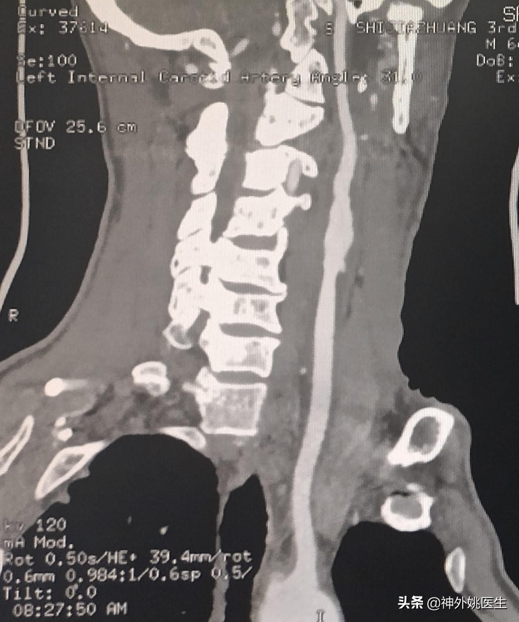 颈内动脉狭窄内膜剥脱术风险大吗,颈动脉内膜摘除手术