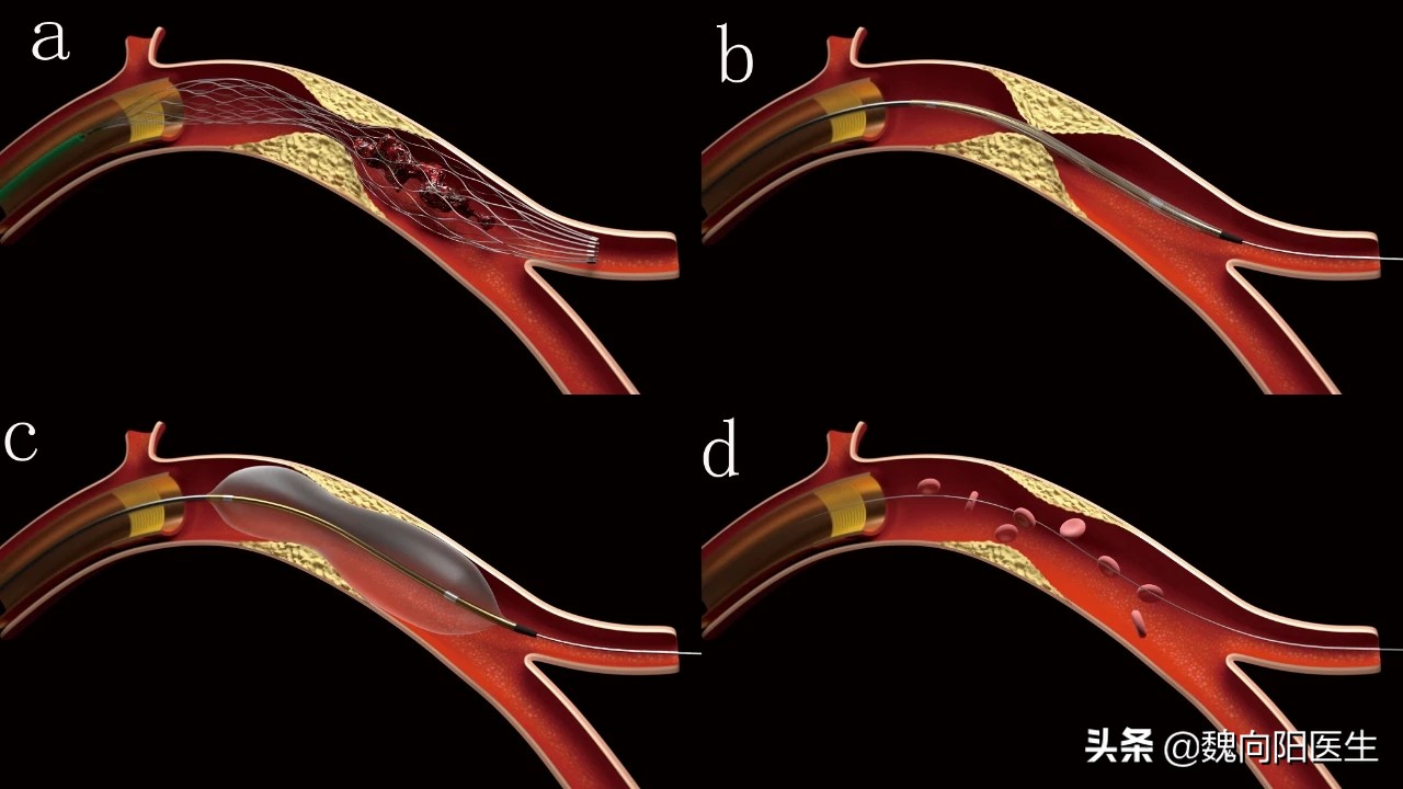 做了胃镜为什么不能吃饭,做胃镜一下子就没有意识了