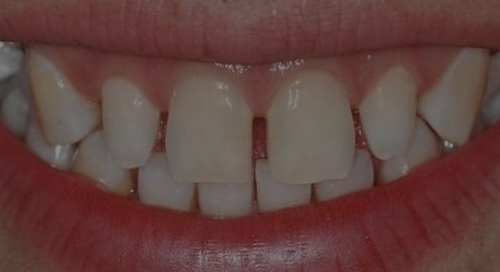 十八岁是矫正牙齿好还是烤瓷牙好,牙齿中线不齐能通过烤瓷牙修复吗